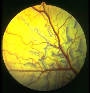 Retinal dysplasia